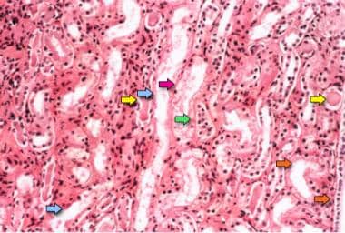 Photomicrograph of a renal biopsy specimen shows r