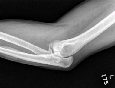 Type 2 coronoid fracture: unstable elbow fracture 