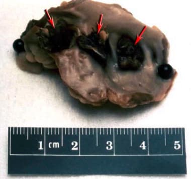 Cardioembolic中风。左心房血栓照片