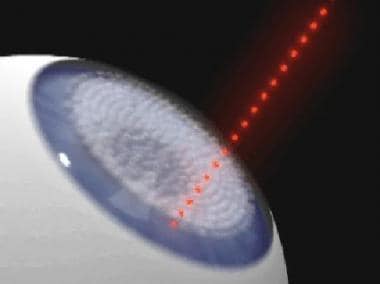 The laser is moved spirally toward the periphery u