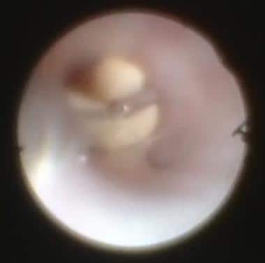 Stone forceps engages 3-mm submandibular duct ston