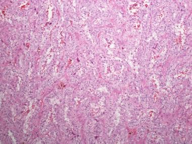 Renal cell carcinoma, clear cell type, Fuhrman gra