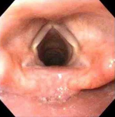 Esophagogastroduodenoscopy (EGD). Normal vocal cor