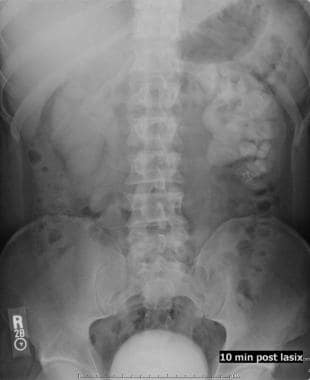 Excretory urography with Lasix: A 10-minute post-L