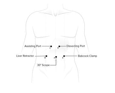 Port placement. These are typical port placements for (A) right liver