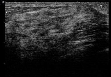 Normal breast ultrasound. This is a younger patien