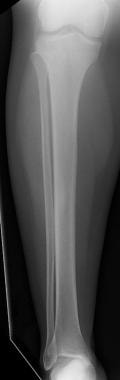 Anterior-posterior radiograph of tibia and fibula.