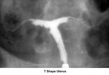 Infertility. T-shaped uterus. Image courtesy of Ja