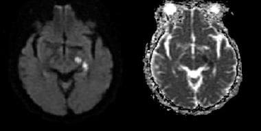 Vascular distributions: Anterior choroidal artery 