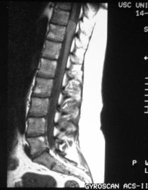 Spinal Meningioma Imaging: Practice Essentials, Computed