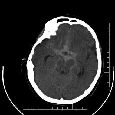 Subarachnoid hemorrhage (SAH). A nonenhanced compu