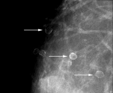 Benign Breast Calcification Imaging Practice Essentials Mammogram