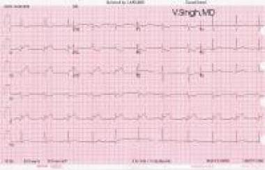 Acute inferior myocardial infarction on an ECG. 