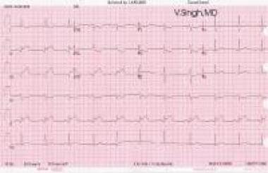 myocardial infarction ecg interpretation