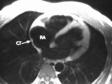 Four-chamber double inversion recovery image: CT i