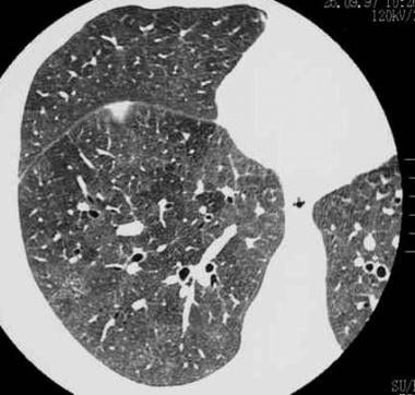 Magnified high-resolution CT (HRCT) scan. 