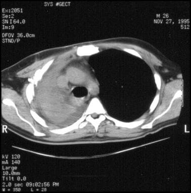 10-mm axial computed tomography (CT) scan of the c
