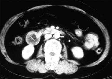 Computed tomography scan showing a large 2-cm aden