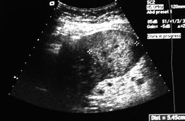 Ultrasound shows hyperechoic mass representing hep