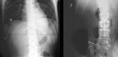 Pneumoperitoneum. Images in a 24-year-old man know
