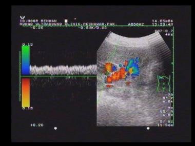 Periportal varices conventional Doppler and power 