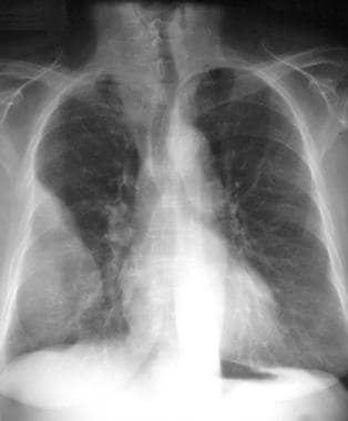 Posteroanterior chest radiograph shows a large, ly