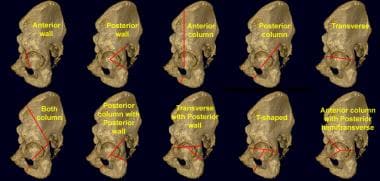 Acetabular fracture classification system. Judet a