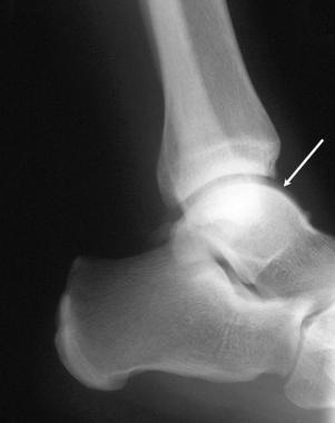 Plain radiograph of the left ankle in a patient wi
