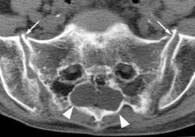 Axial CT of the sacrum reveals 2 large Tarlov cyst