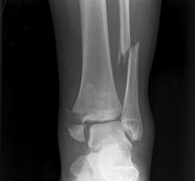 Anteroposterior radiograph from a 27-year-old woma