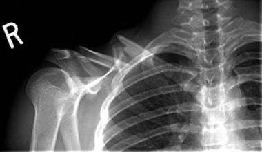 Type 1 comminuted clavicular fracture with skin te