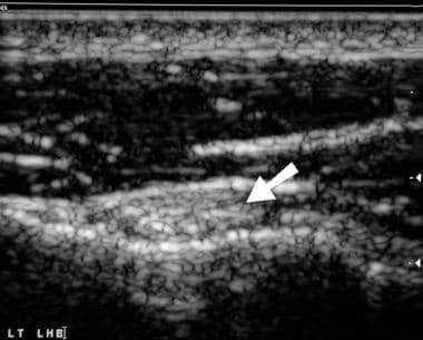 Shoulder, rotator cuff injury (ultrasonography). U