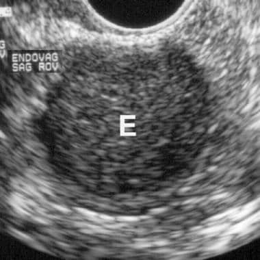 Endovaginal ultrasound scan of an endometrioma. No