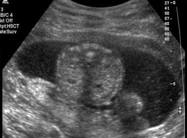 Transverse endovaginal scan in a 29-year-old woman