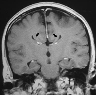 Corpus callosum, agenesis. Coronal T1-weighted MRI
