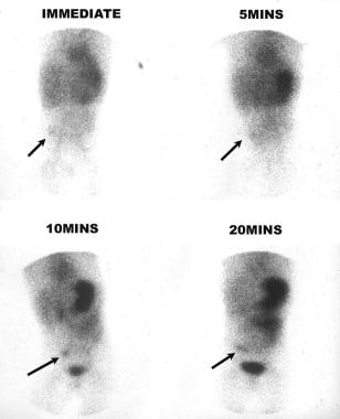 Technetium-99m pertechnetate scan in a 12-year-old