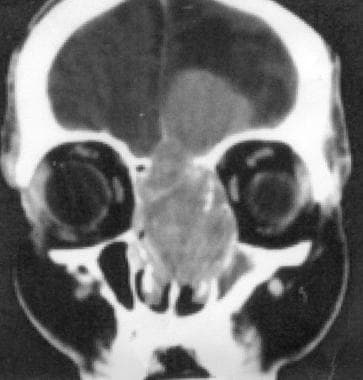 Coronal CT scan of the orbits and sinuses shows a 