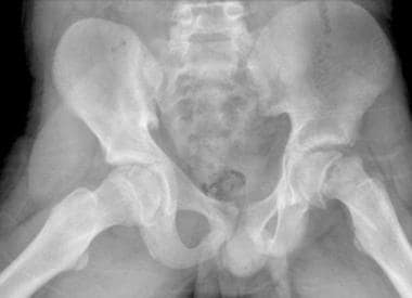Slipped capital femoral epiphysis. Image of a 14-y