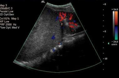 Color Doppler US scan of the right kidney in a sag
