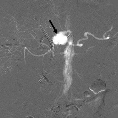 CO2 celiac angiogram in a patient with gastrointes