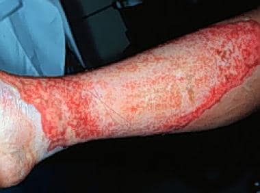 Burn Wound Infections Background Pathophysiology Epidemiology