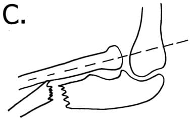 Abnormal radiocapitellar line due to dislocation o