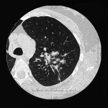 Stage II sarcoidosis. Courtesy of Anthony Notino, 