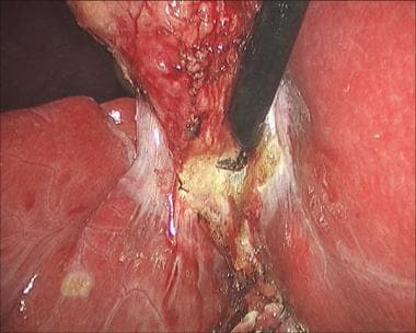 Laparoscopic cholecystectomy. Side-to-side sweepin