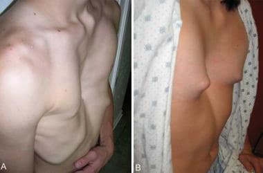 severe pectus excavatum