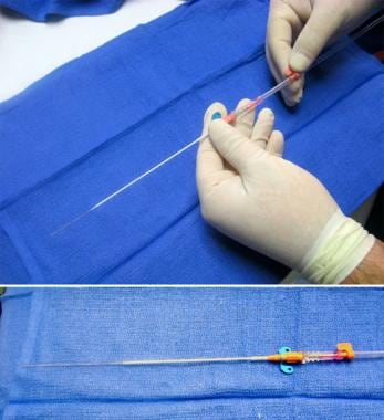 Radial artery cannulation (modified Seldinger). Wi