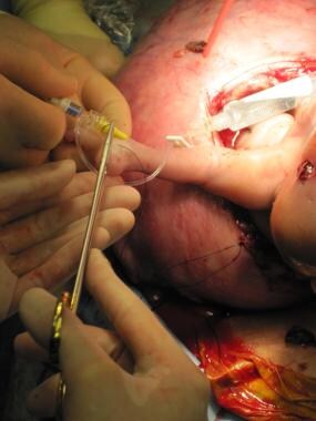 Intravenous access is established in saphenous vei