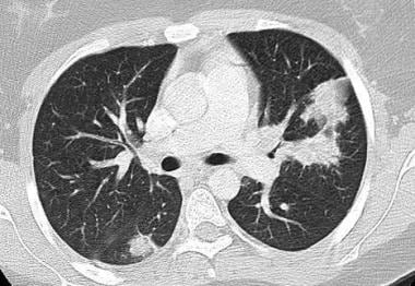 CT chest in a patient with Churg-Strauss syndrome 