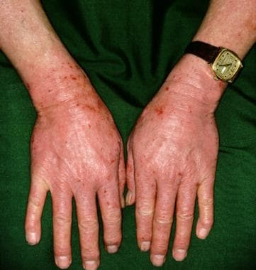 Atorvastatin Side Effects Skin Rash 