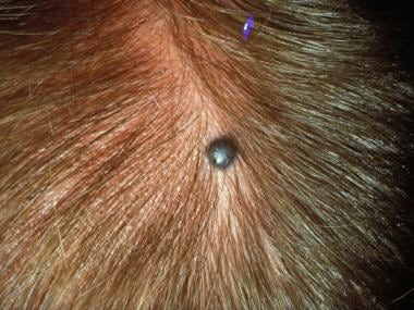 Common blue nevus on the scalp. 